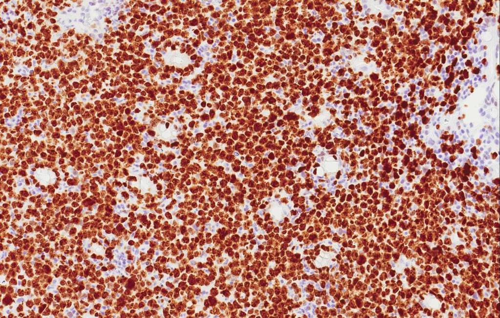 Diffust storcellet B-cellelymfom (diffuse large B-cell lymphoma, DLBCL) H.