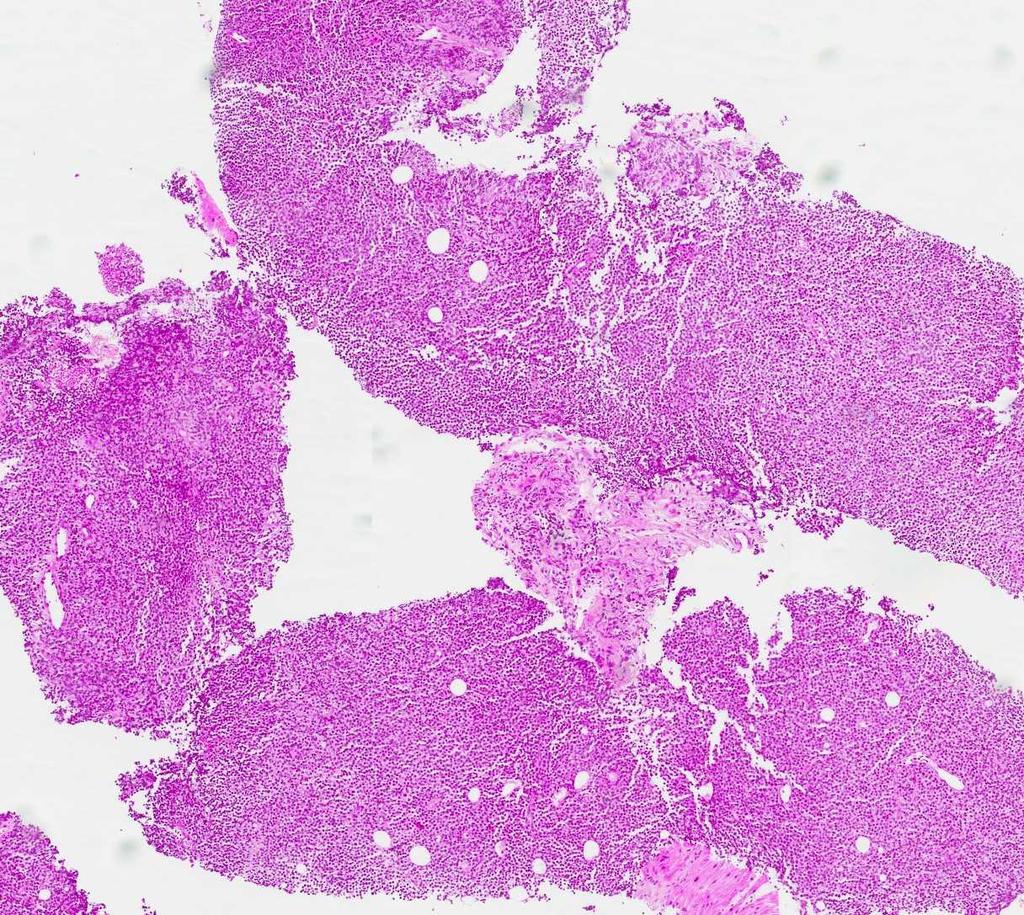 Enteropati-assosiert T-cellelymfom (EATL) Assosiert med cøliaki Utgår fra intraepiteliale T-celler Hyppigst i 60-70 års alder; menn oftere affisert (~3:1) Sees i jejunum og ileum Hyppig
