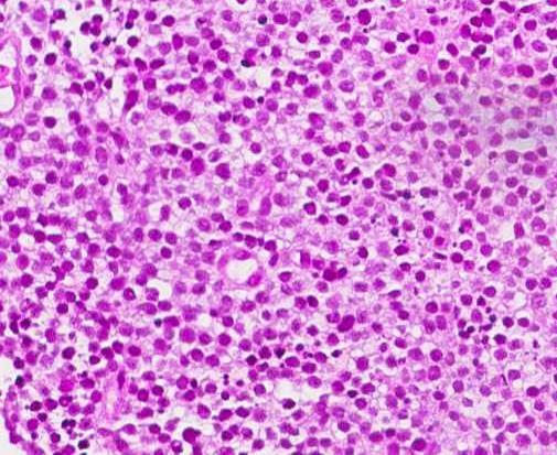 Enteropati-assosiert T-cellelymfom Middels store til store pleomorfe lymfoide celler, ofte med rikelig cytoplasma Ofte kronisk betennelse samtidig Villøs