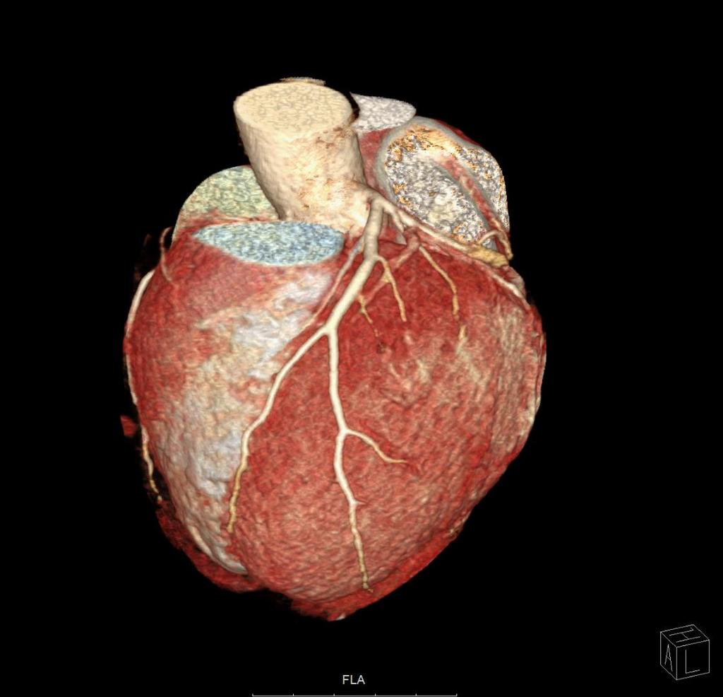 CT coronar angiografi Tett samarbeide med kardiologisk og radiologisk avdeling Henvisninger til kardiologisk avdeling Indikasjon: Risikostratifisering Pasienter med mulig coronarsykdom Invasiv