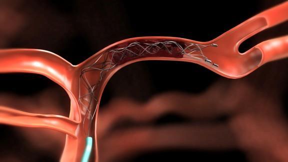 Trombefisking intracerebralt Usikkert når det startes opp Krever teamarbeide: Radiologi og radiografkompetanse, nevrologisk subspes, anestesi, karkirurgi.