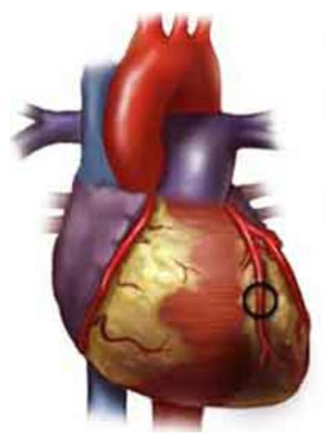 Hjertesykdom og utdanningsnivå Omvendt sammenheng utdanning og koronar hjertesykdom Justering for risikofaktorer http://thepoordiabetic.