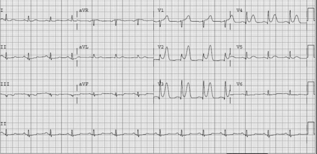 EKG 10 min