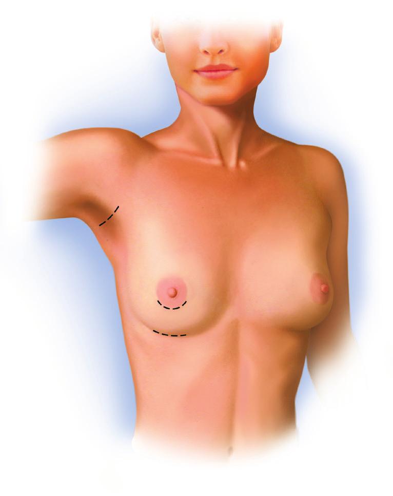 VALG AV SNITT OG PLASSERING Plassering Under en brystforstørrelse blir implantatene plassert enten under brystmuskelen (submuskulært) eller over brystmuskelen (subglandulært).