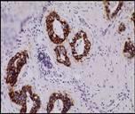 Her-2 overuttrykti cellemembranen hos ca 20% av brystkreftpasienter Normal HER2 reseptor HER2 mrna HER2 positiv Overekspresjon HER2 DNA