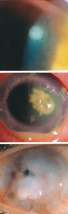BAKTERIELL KERATITT Funn: Synsreduksjon, særlig ved sentral affeksjon. Øyelokkshevelse. Puss. Injisert (rødt) øye.