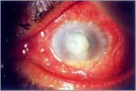 Mindre infiltrat (< 1 mm) der pseudomonas ikke kan utelukkes: Cilox øyedråper.