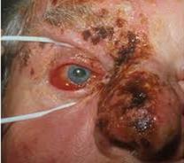 HERPES ZOSTER OPHTHALMICUS Reaktivering av humant herpes