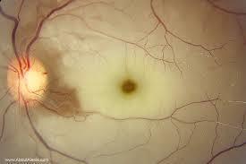 ARTERIE-OKKLUSJONER Symptomer / anamnese: Plutselig unilateralt smerteløst synsfeltutfall. Ev. tidl. episoder med amaurosis fugax. Funn: Hvitlig farging av retina med ødem langs arterie.