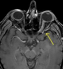 OPTIKUS-NEVRITT Betennelse i synsnerven (nervus opticus) som kan opptre ved papillen (papillitt) eller bak papillen (retrobulbær nevritt). Symptomer / anamnese: Alder gjerne 18-45 år.