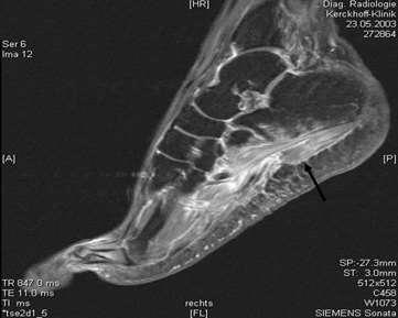 Differentialdiagnoser: Entrapment av gren fra n.