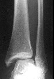 Syndesmoseskade Diagnosen er klinisk Røntgen av ankel pluss hele fibula (rotasjonsfraktur) MR Kirurgi ved