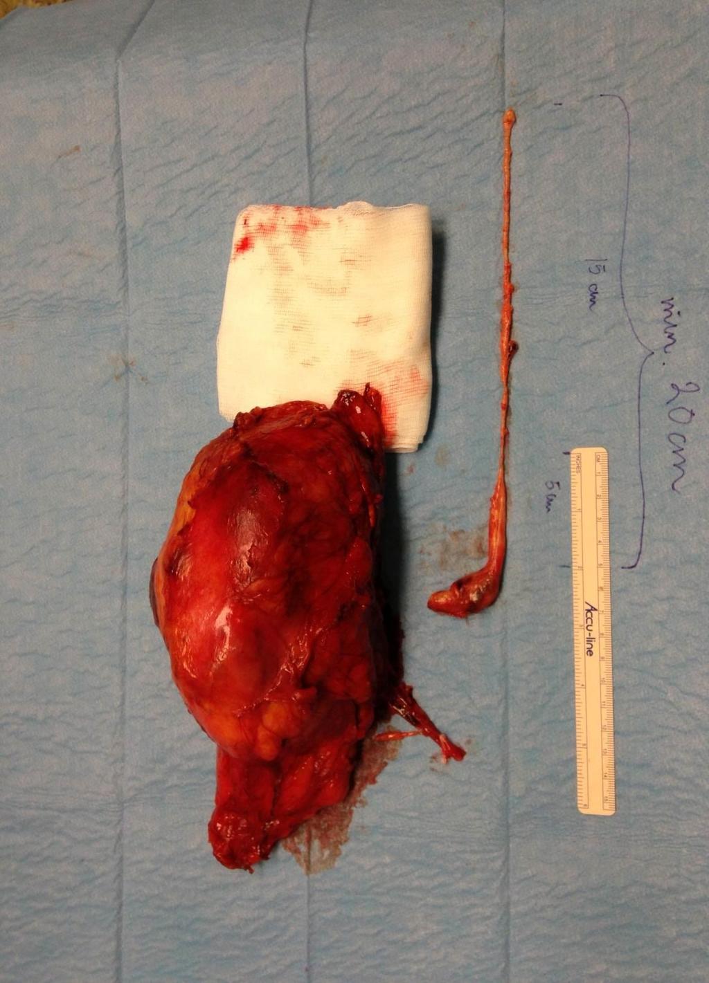 Tumor thrombus in the renal vein or Vena Cava 1-5 % av nyresvulster har sarcomatoide