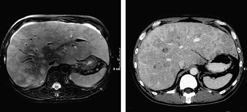 MR vs CT tilsynelatende tilkommede lesjoner