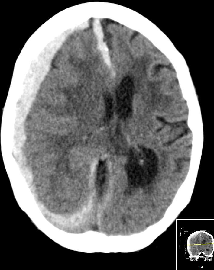 Subduralt hematom Ofte overrivning av brovene Halvmåneformet på CT Økt risiko: o