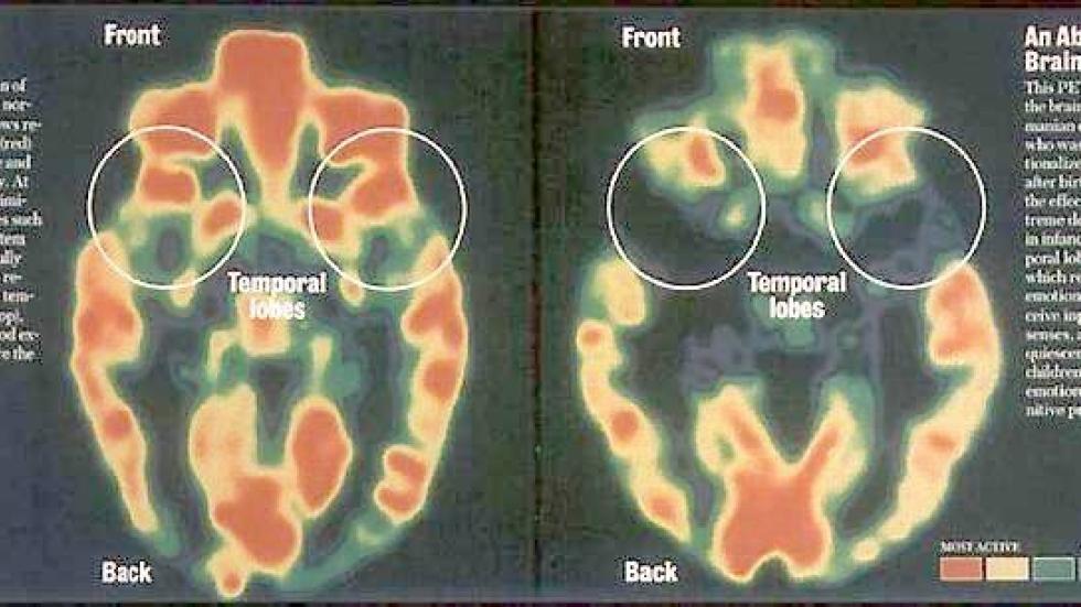 Bildet til venstre viser en normal 3-årings hjerne, bildet til høyre hjernen til en treåring som har vært utsatt for ekstrem omsorgssvikt.