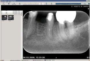 Dersom elektronisk lengdemåling er vanskelig eller gir usikkert resultat, kan røntgen benyttes som eneste metode. Fra tannens lengde (målt på startbildet) trekker vi først fra 10%, og så 1mm.