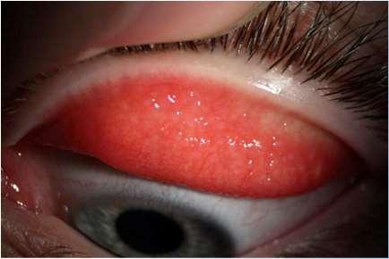 Sjeldent komplikasjoner Obs keratokonus (gnir seg mye i øynene) Allergisk konjunktivitt (sesongbasert eller helårlig) Symptomer: Bilateralt (ev. asymmetrisk).