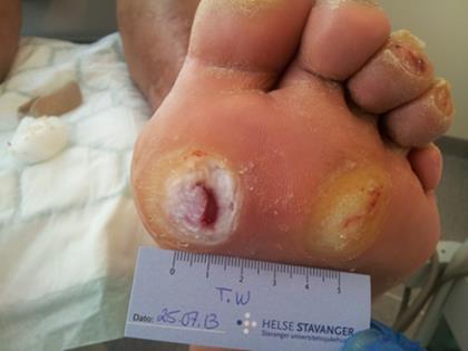 Eksempel på nevropatiske skader/sår: Tannpirker inn i foten Blemme etter ny