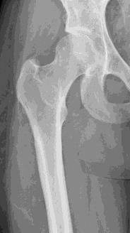 (bekken / skalle, sternum, scapula, costa) Uregelmessige knokler (columna) Bein Remodellering Resorpsjon vs beinnydanning 10-20% per år