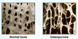 definert tilstand som kan diagnostiseres ved beinmassemåling Kantitet > kvalitet Osteoporose, atrofi av bein Beinmassemåling DEXA / SXA Dual-energy X-ray absorptiometry ct ax proksimalt