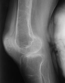 osteoporose, synlig på RTG