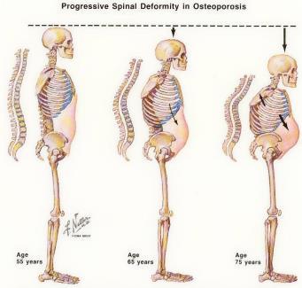 Aksial deformitet ved osteoporose Radiologiske funn ved aksial osteoporose