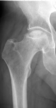 Eksogene / endogene steroider (Cushing syndrom) Røntgen: Osteopeni, frakturer i