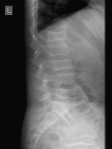 Sekundær generell osteoporose Idiopatisk juvenil osteoporose Sjelden, forbigående barnesykdom