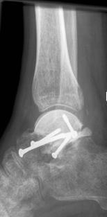 ved artritt Refleksdystrofi (Sudeck atrofi) Transitorisk osteoporose i hoften Regional