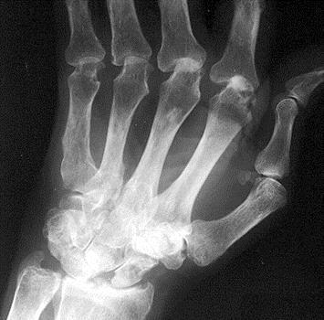 1 pas 2 Regional osteoporose - periartikulær / artritt Oftest i forbindelse med leddsykdom