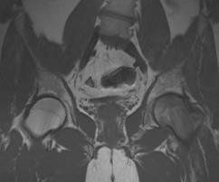 hoftesmerte -RTG: osteoporose i den ene hofteregionen -MR: ødem i samme hofte (mer sensitiv) -spontan