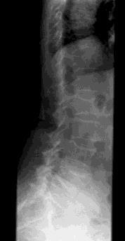 Hyperparathyroidisme Neoplasi - myelomatose fokal resorbsjon (brown tumor) Osteoporose - oppsummering