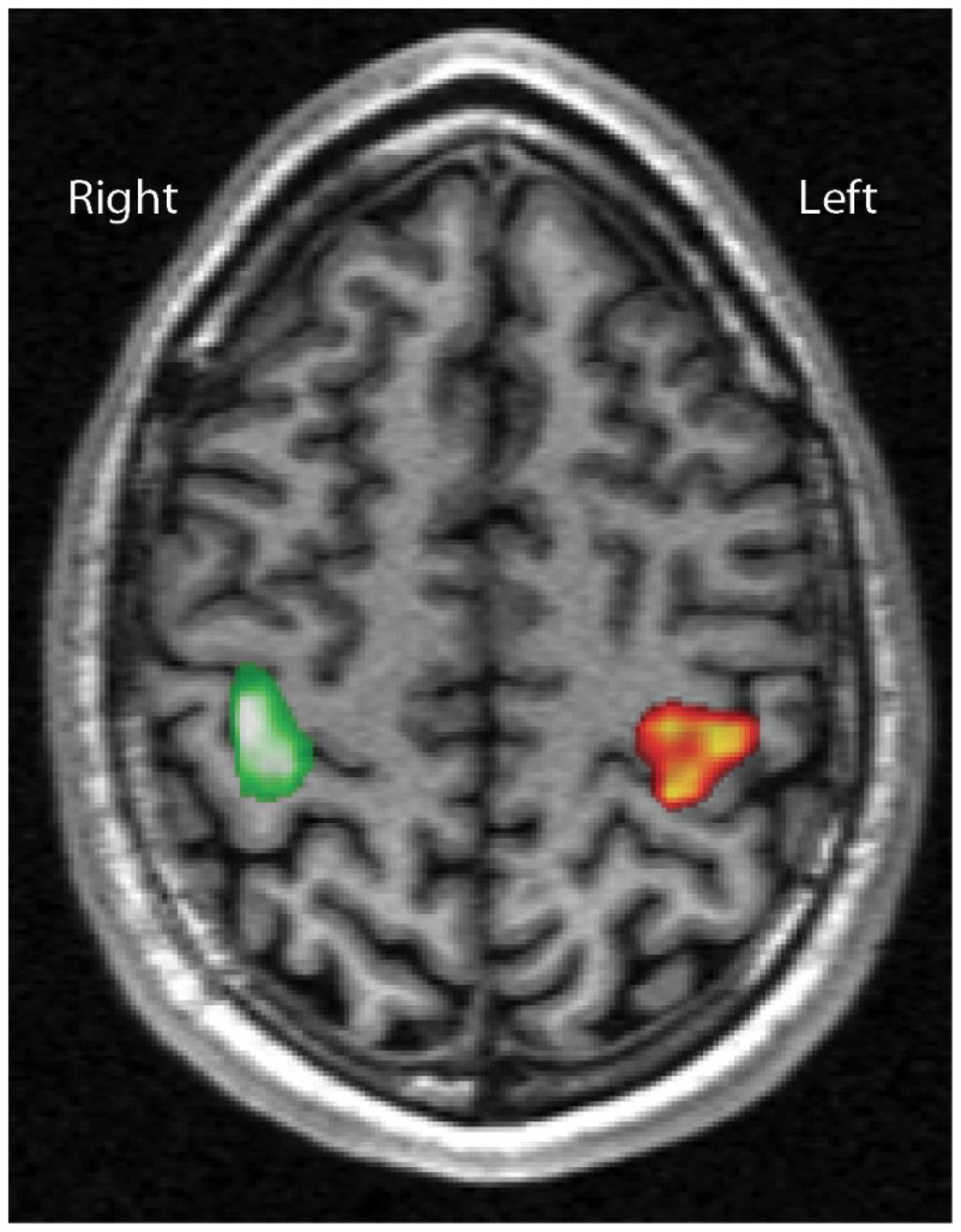 Område i motorisk korteks (MI) som aktiveres ved fingertapping L R BOLD fmri-signal (fargekodet) er overlagret T1-vektet bilde.