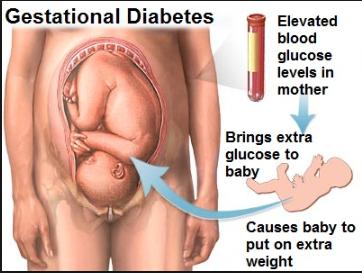 Folkehelseperspektiv- En triade Hyperglykemi- Pregravid uoppdaget diabetes mer alvorlig enn