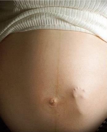 Blødninger under svangerskapet 1 av 4 som føder har hatt blødninger under svangerskapet.
