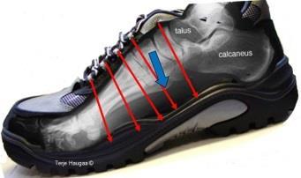Et praktisk eksempel til der skoen er en etiologisk faktor.