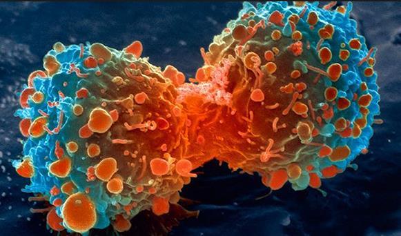 Sekundær kreft Hematologiske (leukemi, myelodysplastisk syndrom) Høyest relativ risiko Kjemoterapi spesielt stoffer som skader cellens DNA (alkylerende stoffer, etoposid) Solide svulster Høyest