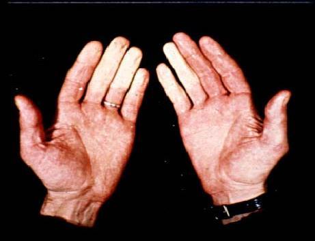 Perifer nevropati/raynaud fenomen Taxol/ Taxotere: Brystkreft, Prostatakreft Cisplatin/