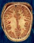 Epidural og spinalpunksjon Ved epiduralanestesi sprøytes anestesimiddel inn i epiduralrommet (rommet mellom dura mater og virvelsøylen).