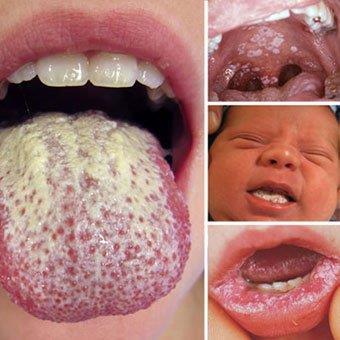 Candidiasis Risiko Eldre Orale steroider eller ab