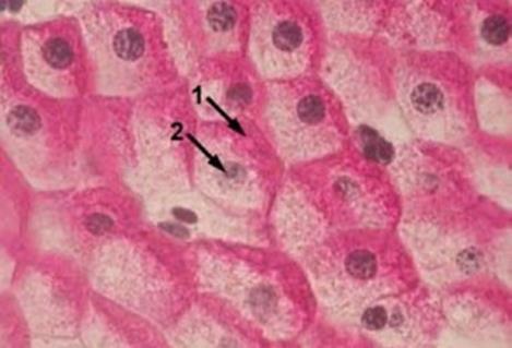 Hypoglykemi Makrosome nyfødte Skyldes hyperinsulisme Gir seg ofte etter 2-4 dager Hvis lengre, vurder utredning