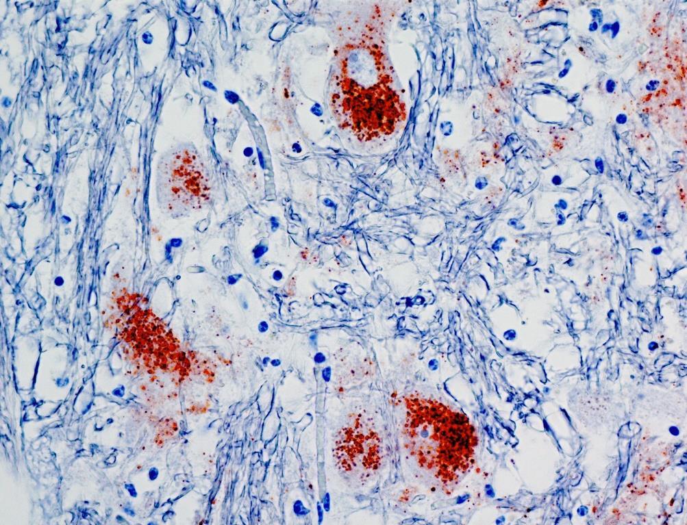 Figur 2.10. Vevssnitt fra elg farget ved hjelp av immunhistokjemi som viser prioner i hjernevev. Foto: Sylvie Benestad, Veterinærinstituttet.