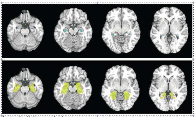 episodisk minne DW-MRI Hyppig fokus for lesjoner i