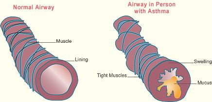 Astma - Bind 1 s 70-71 Anfallsvis opptreden av pustebesvær som følge av obstruksjon i de små luftveiene Hulrommet i bronkiene
