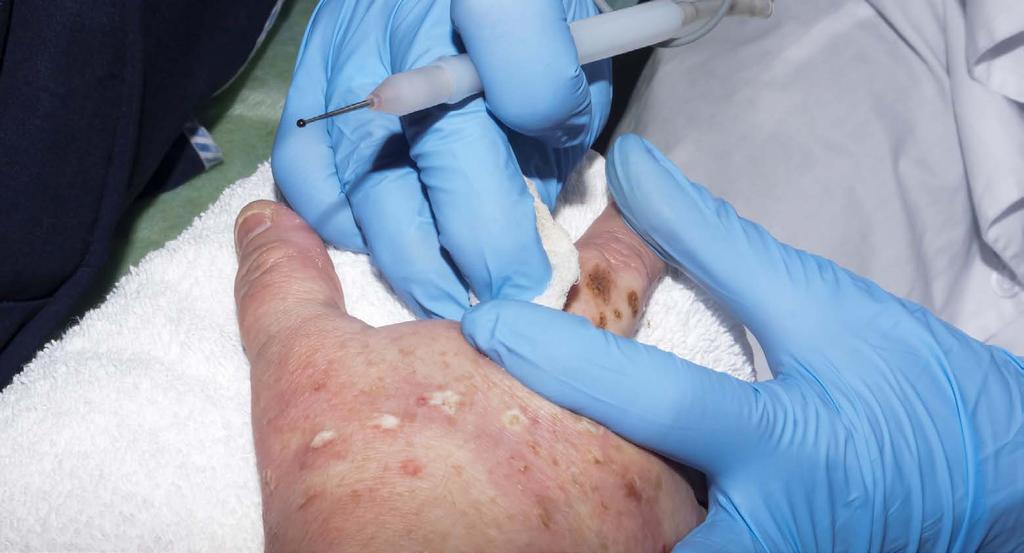 ERN for hudsykdommer (ERN Skin) 34 Mange hudsykdommer har en alvorlig innvirkning på pasientene og kan være assosiert med risiko for kreft.