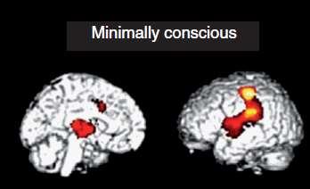 Smerter Studier viser at pasienter i MBT har aktivering i samme hjerneområder som friske