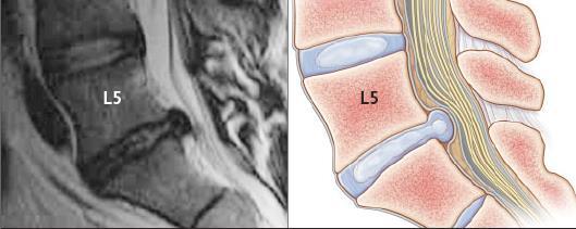 Skiveprotrusjon L5-S1 er