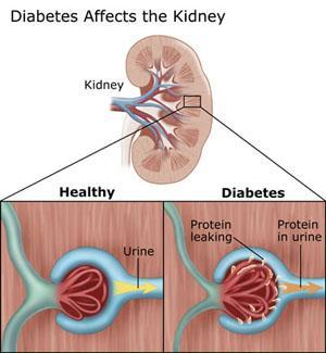 Diabetisk nyresykdom En senkomplikasjon til diabetes er nyreskade og evt nyresvikt.