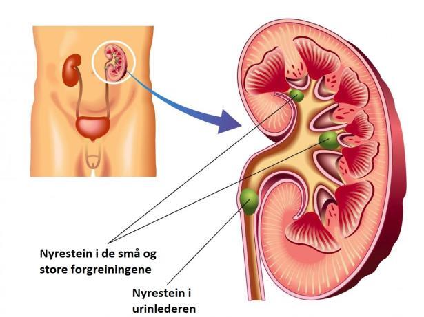 Kan befinne seg i nyrene, i urinlederne eller i blæren. Rammer ofte personer i alderen 30-40 år.